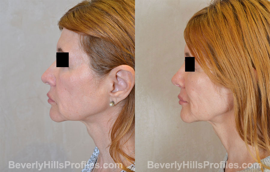 Rhinoplasty Before and After Photo Gallery - female, side view