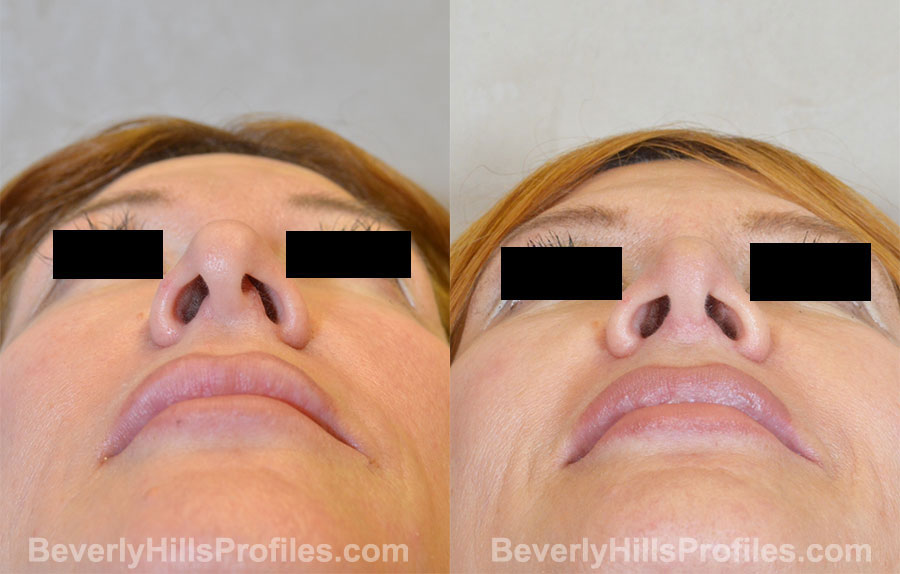 Rhinoplasty Before and After Photo - female, bottom view