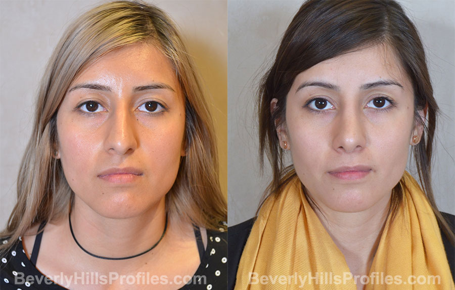Rhinoplasty Before and After Photo - female, front view
