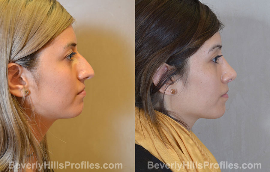 Rhinoplasty Before and After Photo - female, right side view