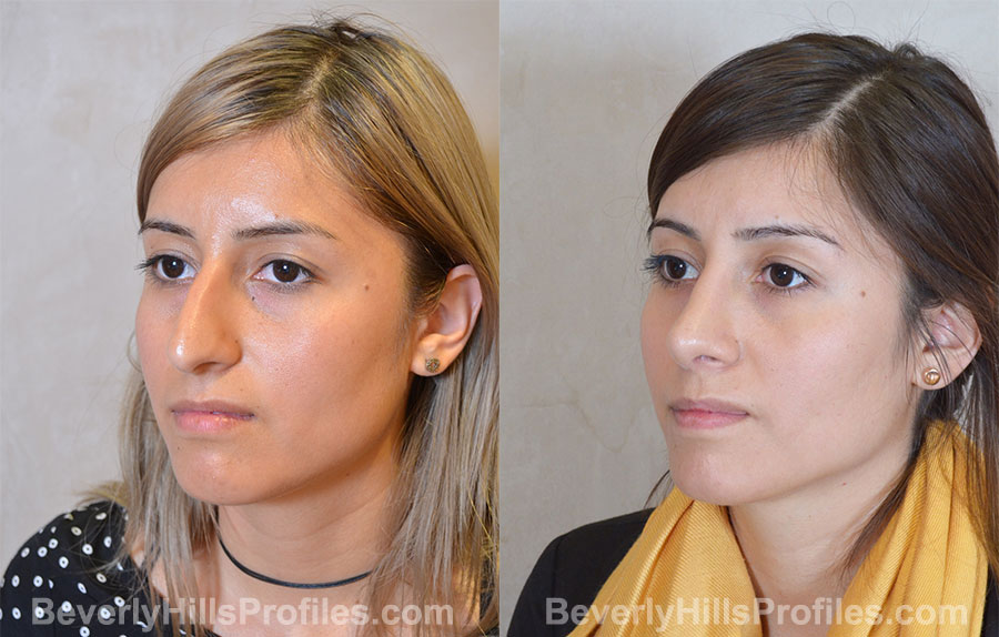Rhinoplasty Before and After Photo - female, oblique view
