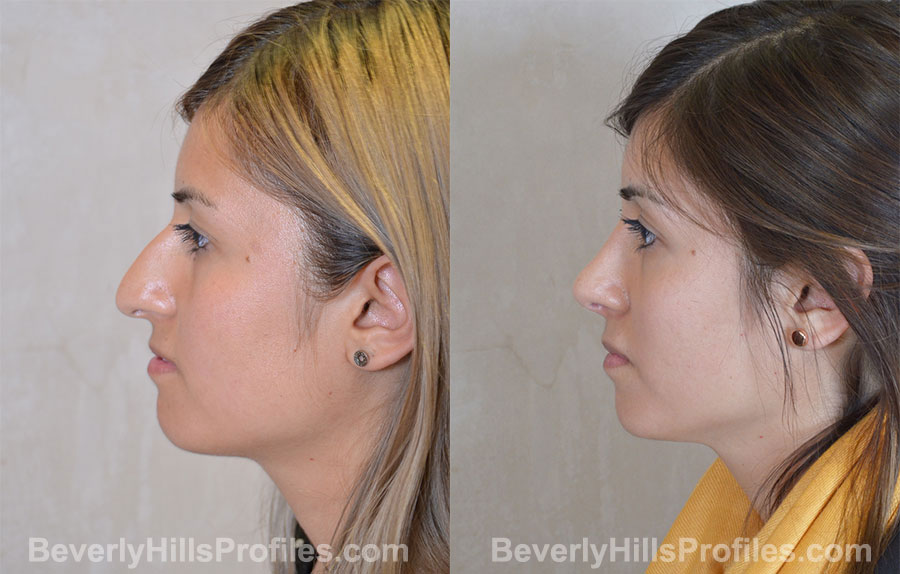 Rhinoplasty Before and After Photo - female, side view