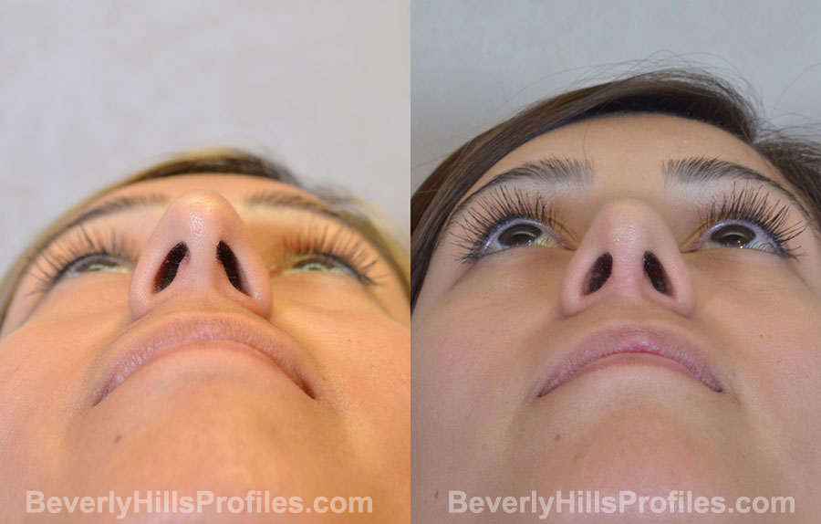 Rhinoplasty Before and After Photo - female, bottom view