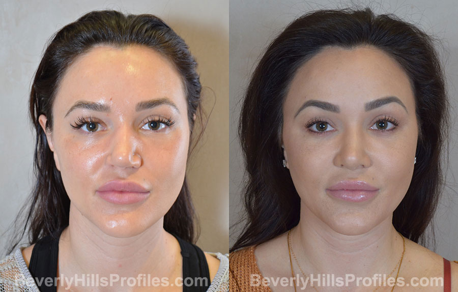 Rhinoplasty Before and After - female, front view