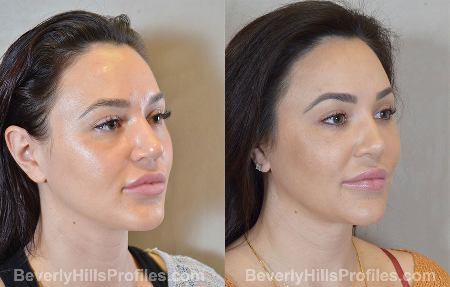 Rhinoplasty Before and After - female, right oblique view