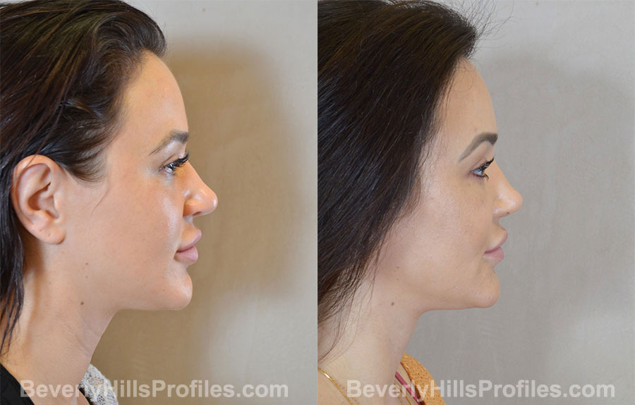 Rhinoplasty Before and After - female, right side view