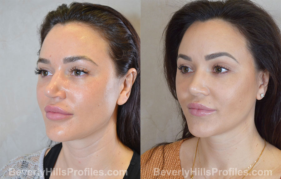 Rhinoplasty Before and After - female, oblique view