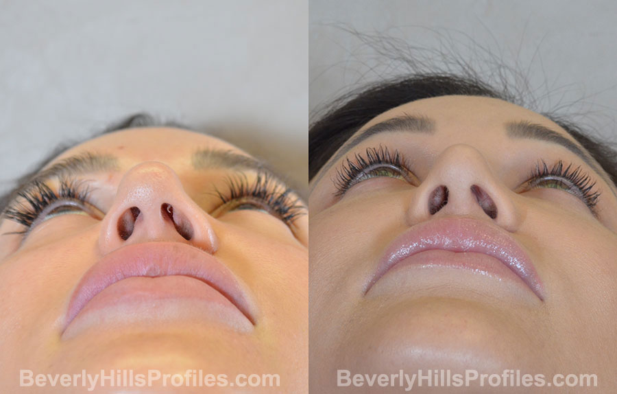 Rhinoplasty Before and After - female, bottom view