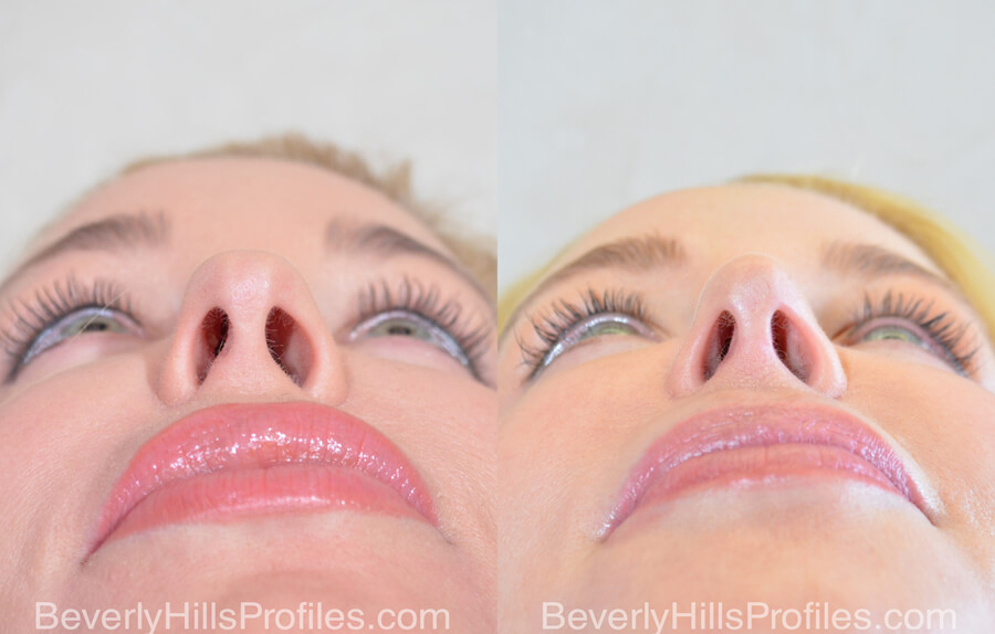 Nose Job Before After - female, bottom view