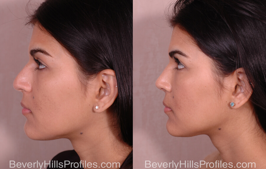 Nose Job Before and After - female, side view