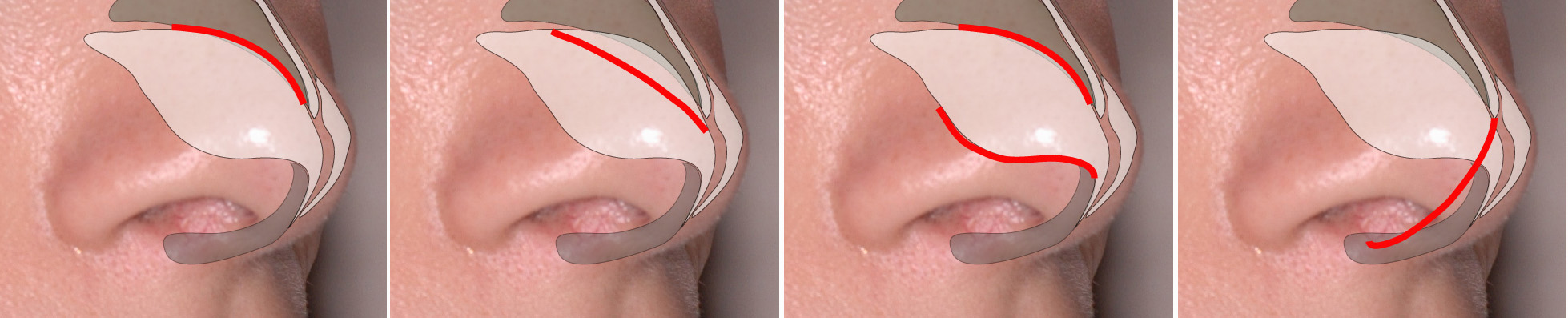 internal incisions (shown in red) - closed rhinoplasty