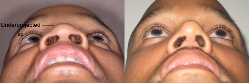 african american before and after 3 months after Nose Jobs - bottom view