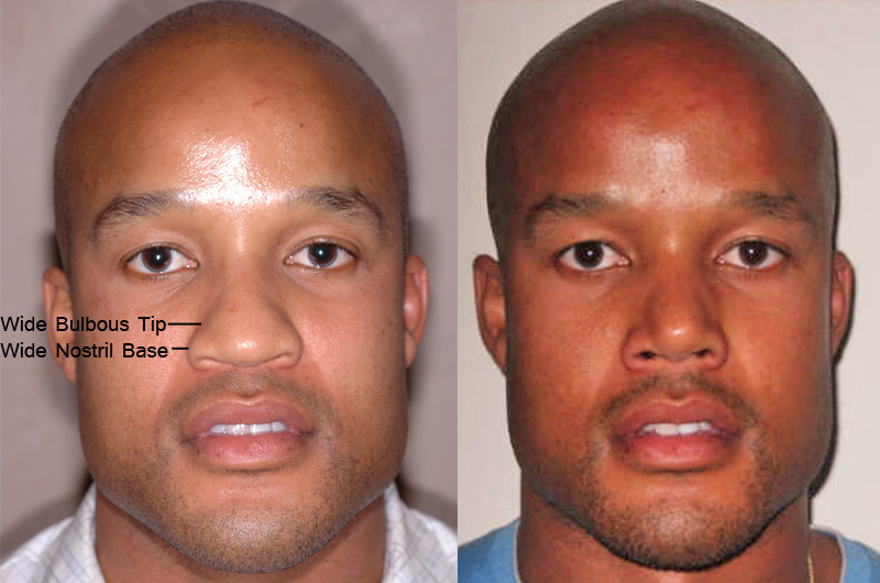 african american before and after 3 months after Nose Jobs - front
