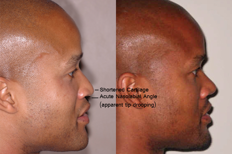 african american before and after 3 months after Nose Jobs - profile
