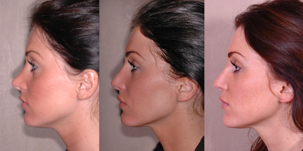 before (left), 10 days (middle), and 4 months (right) after revision rhinoplasty