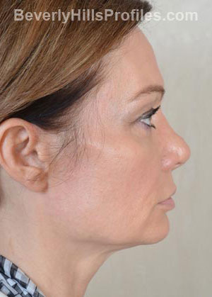 Female face - before Fat Grafting treatment, right side view, patient 1