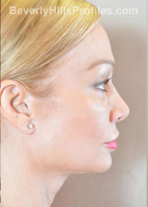 Female face - after Fat Grafting treatment, right side view, patient 1