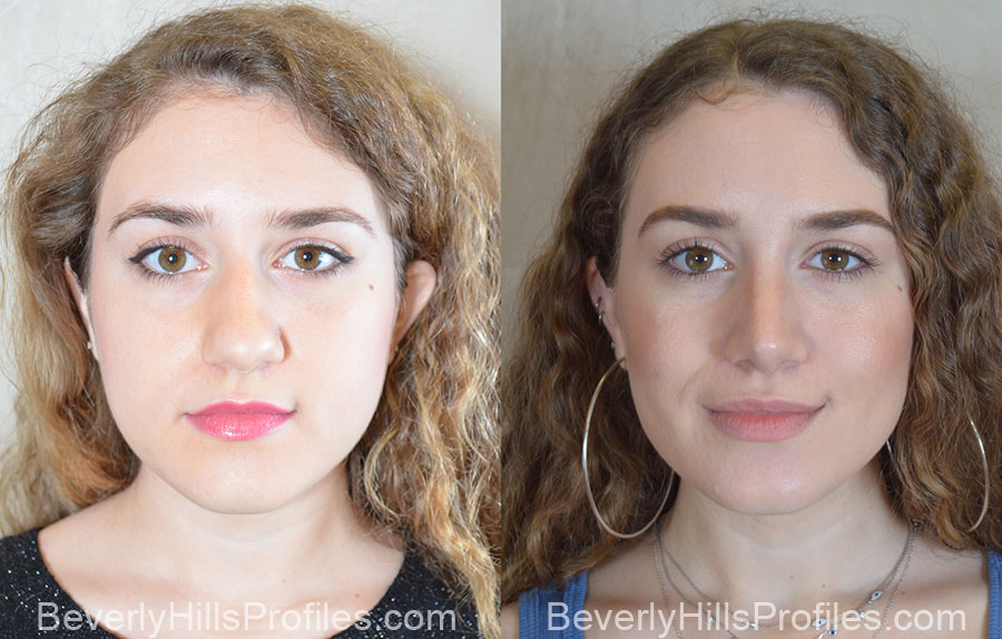 How To Get A Smaller Nose Without Makeup Saubhaya Makeup