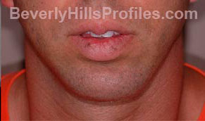 Chin Implants. After Treatment Photo - male, front view, patient 1