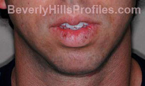 Chin Implants. Before Treatment Photo - male, front view, patient 1