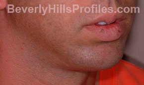 Chin Implants. After Treatment Photo - male, oblique view, patient 1