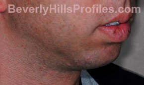 Chin Implants. Before Treatment Photo - male, oblique view, patient 1