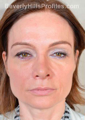 Female face - before Fat Grafting treatment, front view, patient 1