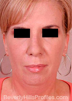 Mini Facelift Surgery Before Treatment Photo - female, front view, patient 3