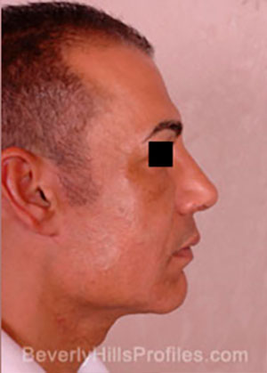 Male face after Revision Facelifts treatment, right side view, patient 2