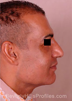 Male face before Revision Facelifts treatment, right side view, patient 2
