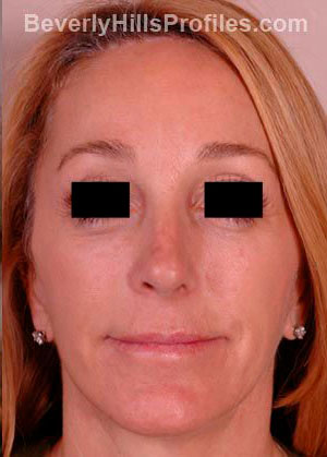 Female face after Revision Facelifts treatment, front view, patient 1