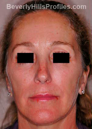Female face before Revision Facelifts treatment, front view, patient 1