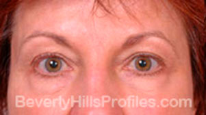 Blepharoplasty Before Treatment Photo - female, front view, patient 2