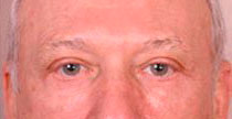 Blepharoplasty After Treatment Photo - male, front view, patient 1