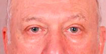 Blepharoplasty Before Treatment Photo - male, front view, patient 1