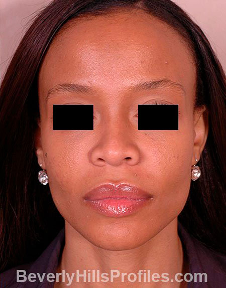 AFRICAN AMERICAN RHINOPLASTY - After Treatment Photo: female front view, patient 1
