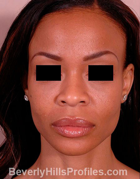 AFRICAN AMERICAN RHINOPLASTY - Before Treatment Photo: female front view, patient 1