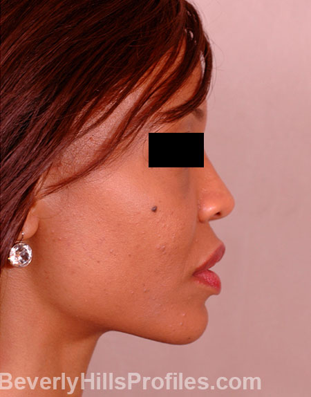 AFRICAN AMERICAN RHINOPLASTY - After Treatment Photo: female right side view, patient 1