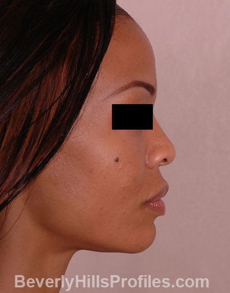 AFRICAN AMERICAN RHINOPLASTY - Before Treatment Photo: female right side view, patient 1