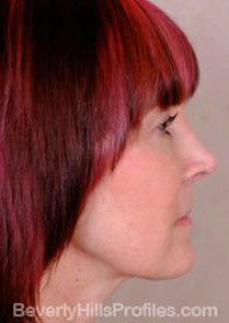 Female face - after Neck lift treatment, neck, right side view, patient 1