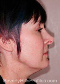 Female face - before Neck lift treatment, neck, right side view, patient 1