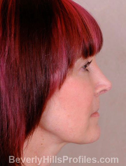 Female fece, after Rhinoplasty Mistakes treatment, right side view - patient 2