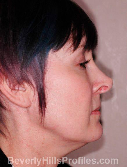 Revision Rhinoplasty Before Photo Gallery - female, side view