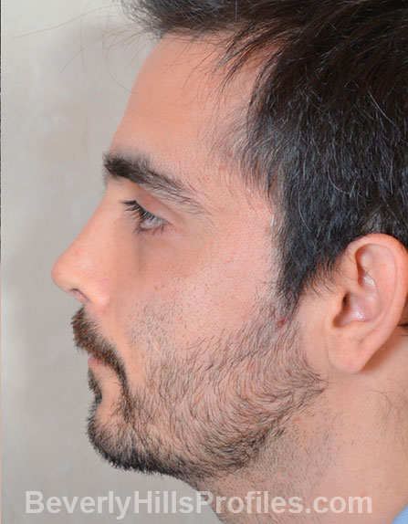 Male fece, after Rhinoplasty Mistakes treatment, left side view, patient 1