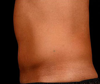 Male tummy - after SculpSure treatment, patient 2 (left side view)