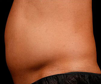 Male tummy - before SculpSure treatment, patient 2 (left side view)