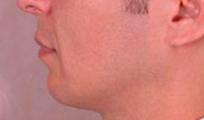 Chin Implants. After Treatment Photo - male, left side view, patient 2