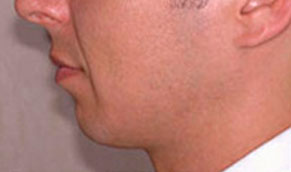 Chin Implants. Before Treatment Photo - male, left side view, patient 2