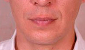 Chin Implants. After Treatment Photo - male, front view, patient 2