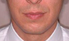 Chin Implants. Before Treatment Photo - male, front view, patient 2